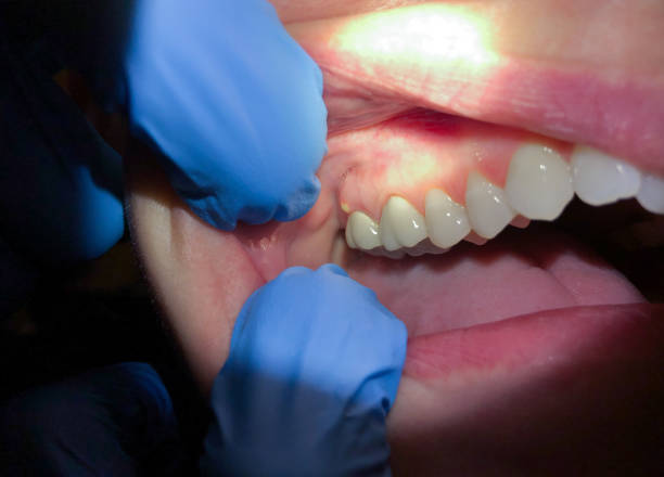 Best Cracked Tooth Emergency Dentist  in Cordaville, MA